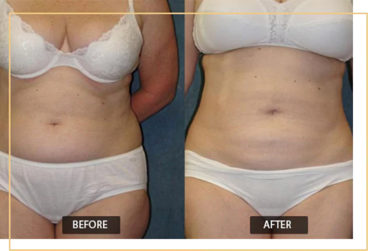 Abdomen Liposuction in Delhi