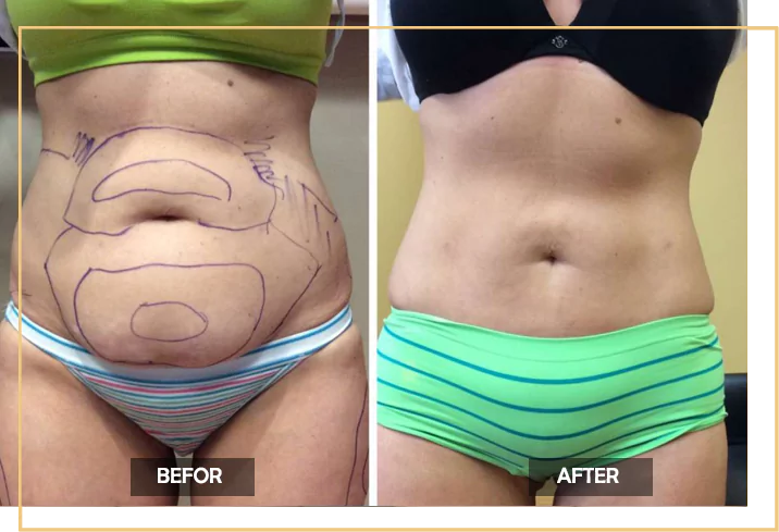 Abdomen Lipo in Delhi