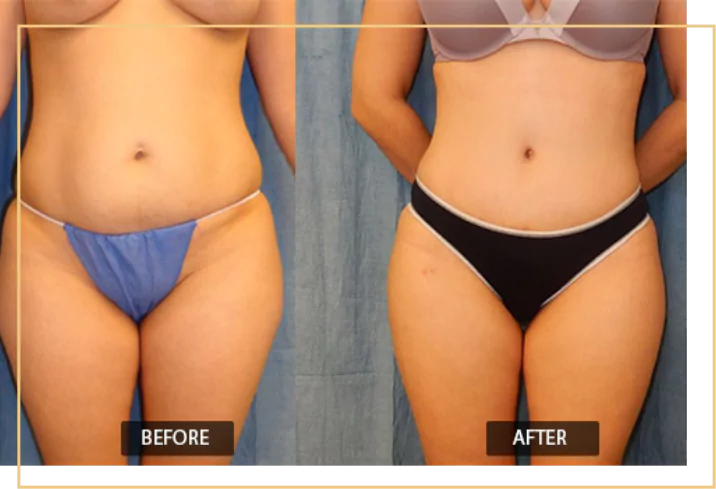 Belly Fat Removal in Delhi