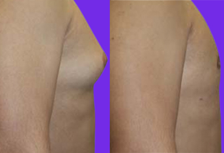 Gynecomastia surgery in Delhi