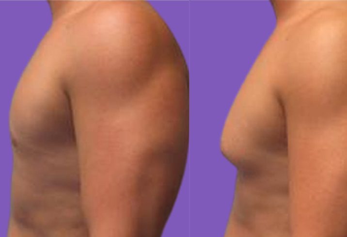 Gynecomastia treatment in Delhi