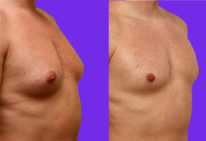 Male Breast Reduction surgery in Delhi