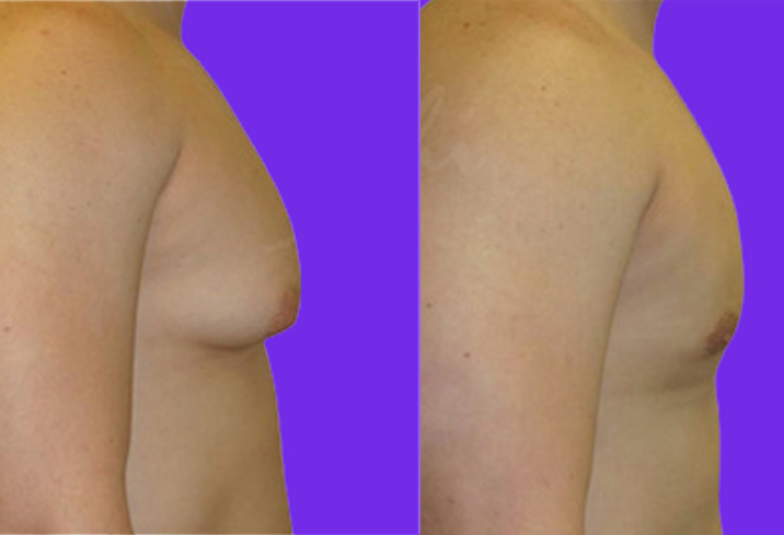 Male Breast Reduction in Delhi