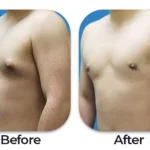 Gynecomastia