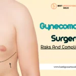 Gynecomastia Surgery Risks