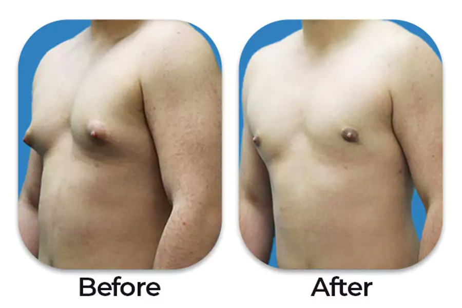 Gynecomastia