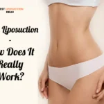 laser liposuction