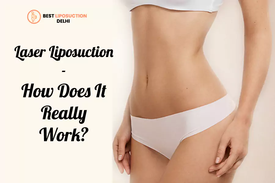 laser liposuction