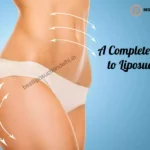 liposuction
