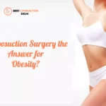 liposuction vs bariatric
