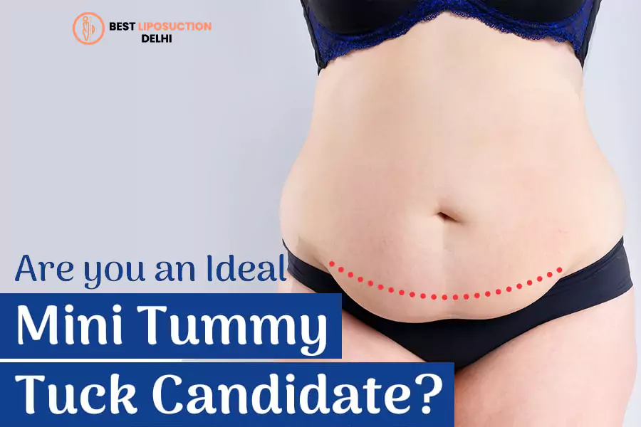 Tummy Tuck