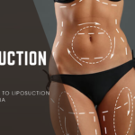 #liposuction